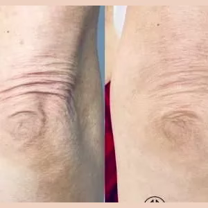 Skin Tightening Elbow