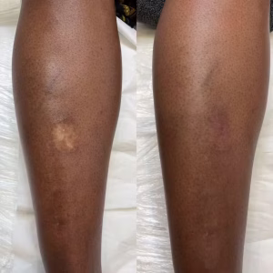 scar camouflage before and after