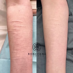 self harm scar before and after CO2