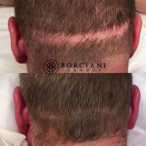 Scar Camouflage Hair Restoration