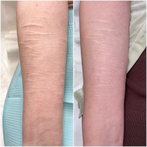 self harm scar before and after