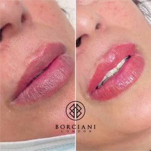 Lip Blush Treatment Before and after