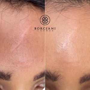 FacialScar Treatment Before and after