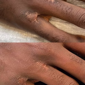scar camouflage before and after
