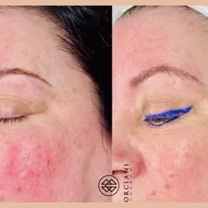 Thread Vein Treatment