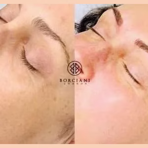 Skin Tightening and pigmentation