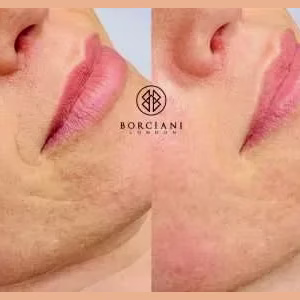 Skin Tightening