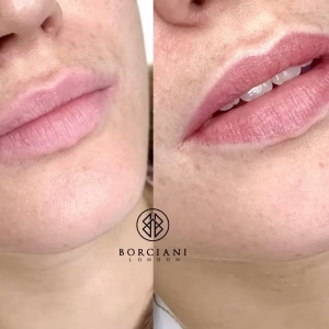 Lip Blush Treatment Before and after
