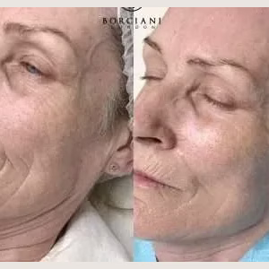 Skin Tightening