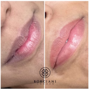 Lip Neutralisation Treatment