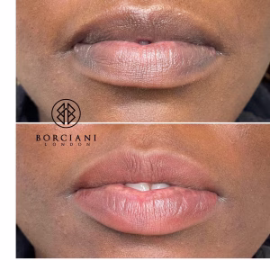 Lip Neutralisation Treatment