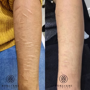 self harm scar before and after