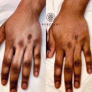 scar camouflage before and after