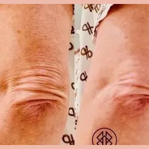 Skin Tightening Elbow