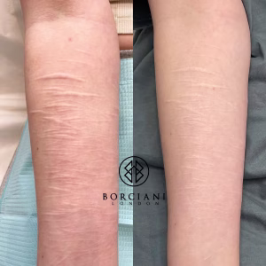 Self harm scar before and after