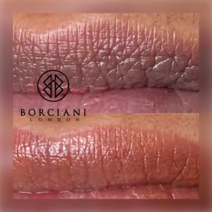 Lip Neutralisation Treatment