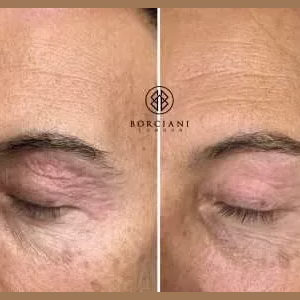 Eyelid Tightening