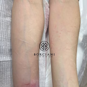 self harm scar before and after CO2 and camouflage