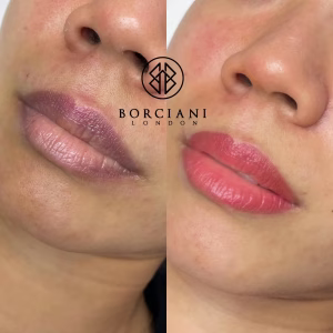 Lip Neutralisation Treatment