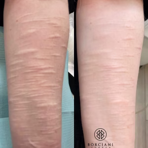 self harm scar before and after
