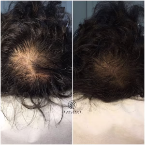 Hair Loss Treatment