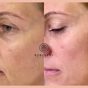 Skin Tightening