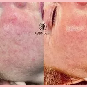 skin rejuvenation gallery