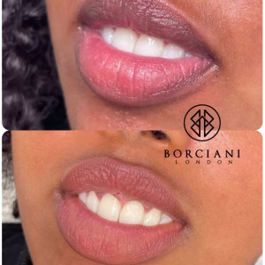 Lip Neutralisation Treatment