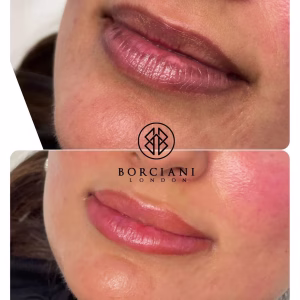 Lip Neutralisation Treatment
