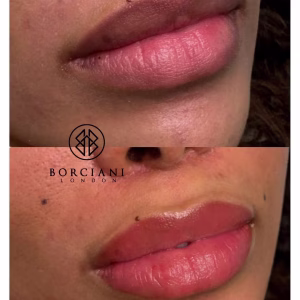 Lip Neutralisation Treatment