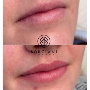 Lip Blush Treatment Before and after