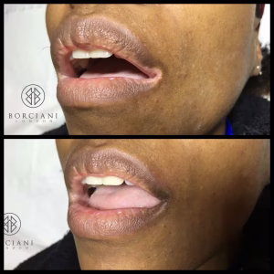 vitiligo before and after