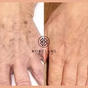 Hand Rejuvenation