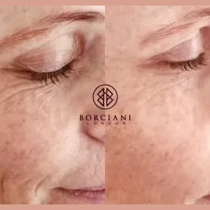 Crows Feet Treatment