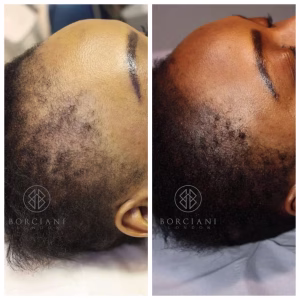 Hair Loss Treatment