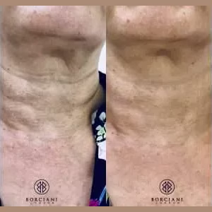 Skin Tightening Neck