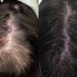 hair loss gallery