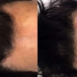 hair loss gallery
