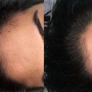 hair loss gallery