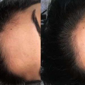 hair loss gallery