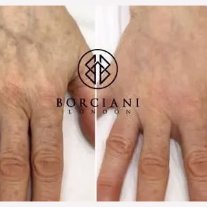 Hand Rejuvenation