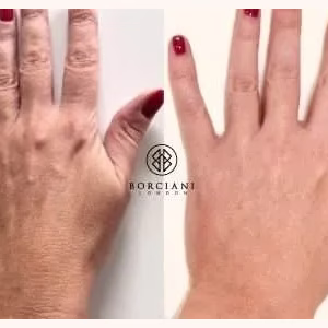 Hand Rejuvenation