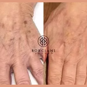 Hand Rejuvenation and Pigmentation