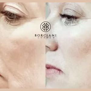 Skin Tightening