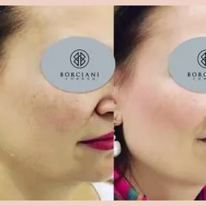 Skin Tightening