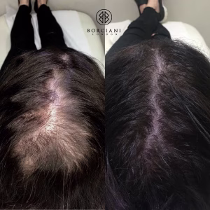 Hair Loss Treatment
