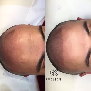 Hair Loss Treatment