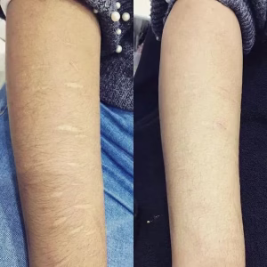 self harm scar before and after