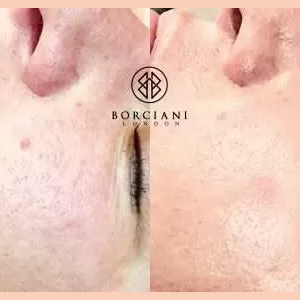 Skin Texture Improvement