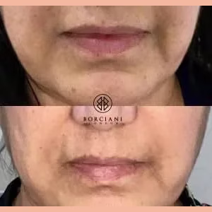 Skin Tightening
